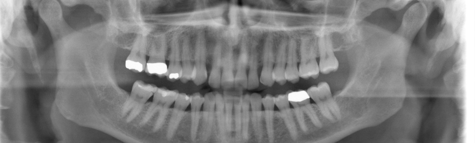 X-ray film scanning and digitisation